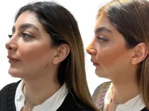 فیلر چانه فیلر چانه