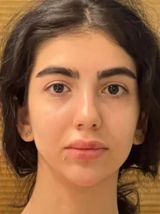 فیلر زاویه فک