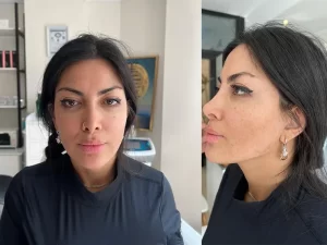 فیلر فول فیس فیلر فول فیس