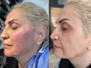 تزریق فیلر فول فیس تزریق فیلر فول فیس