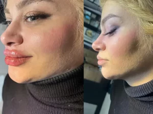 فیلر لب روسی فیلر لب روسی