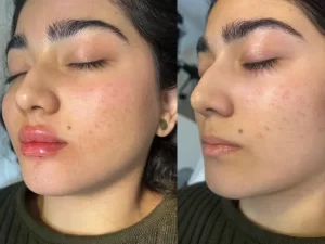 فیلر لب فیلر لب