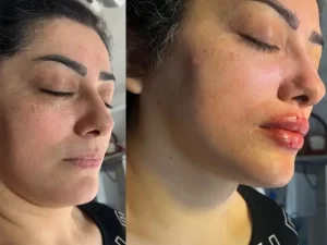 تزریق فیلر لب تزریق فیلر لب