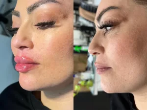 تزریق فیلر لب تزریق فیلر لب