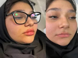 فیلر لب فیلر لب